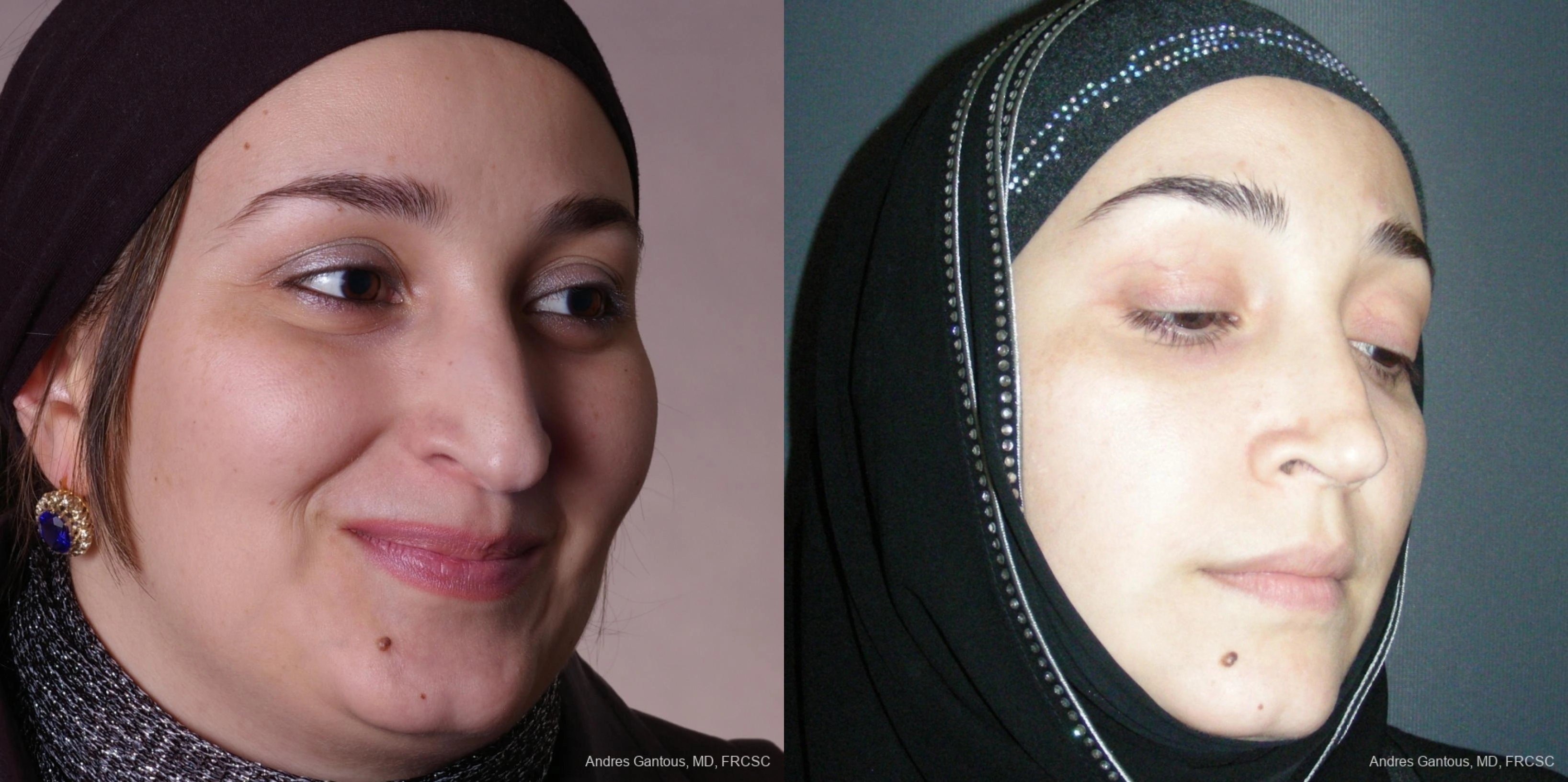 Rhinoplasty - Thumbnail 3