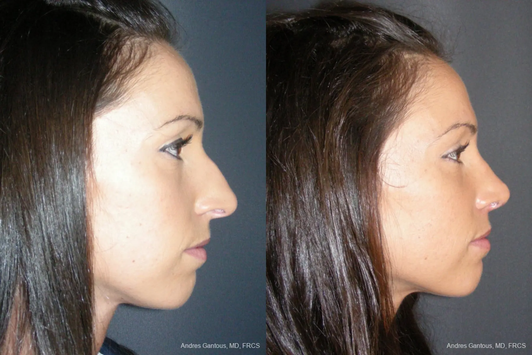 Rhinoplasty: Patient 52 - Before and After 5