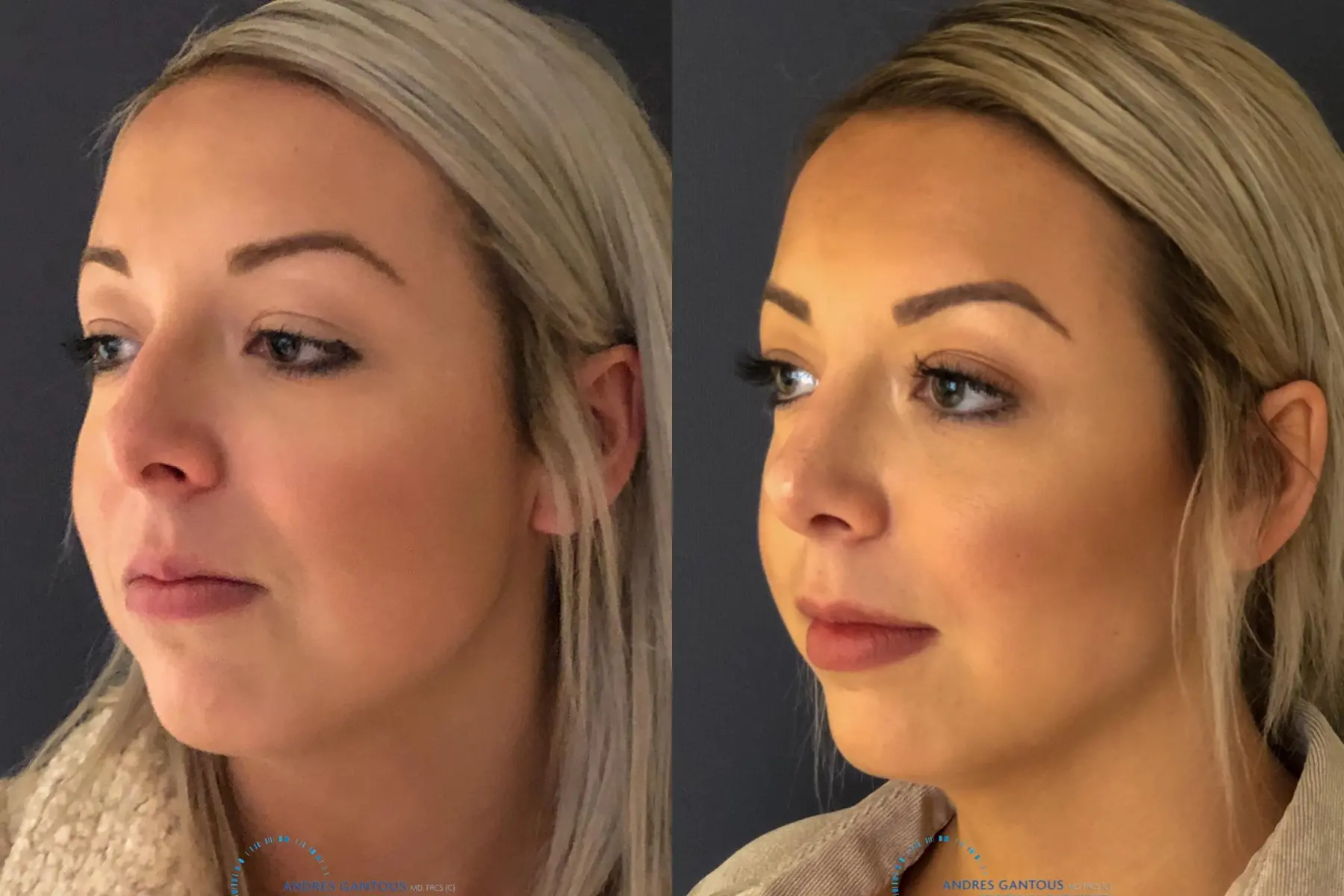 Rhinoplasty: Patient 69 - Before and After 3