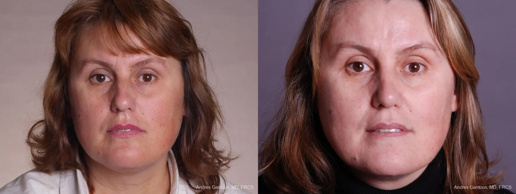 Rhinoplasty: Patient 47 - Before and After  