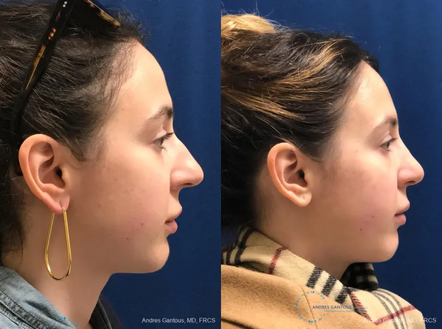 Rhinoplasty: Patient 84 - Before and After 5