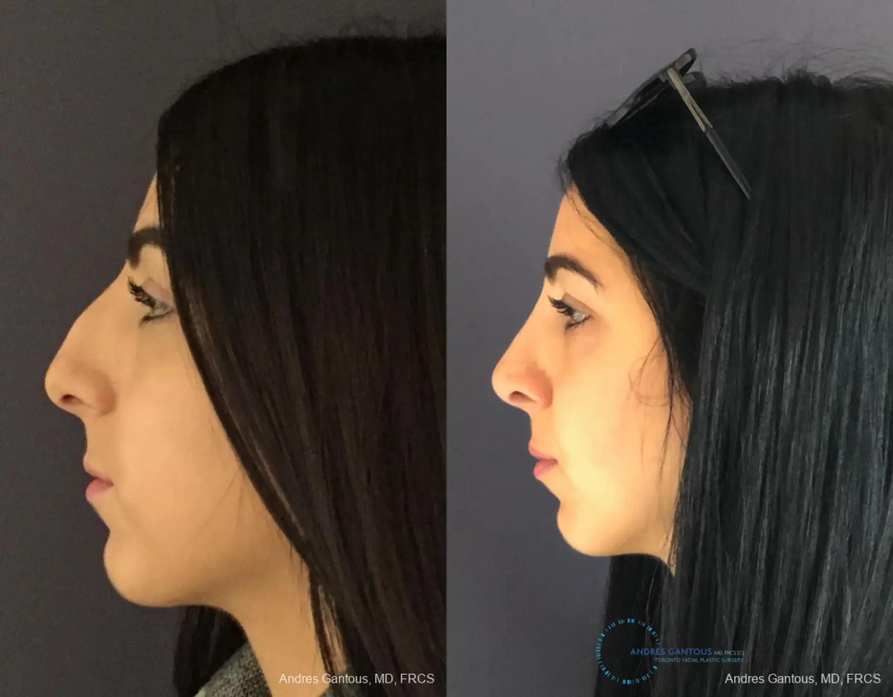 Rhinoplasty: Patient 85 - Before and After 6