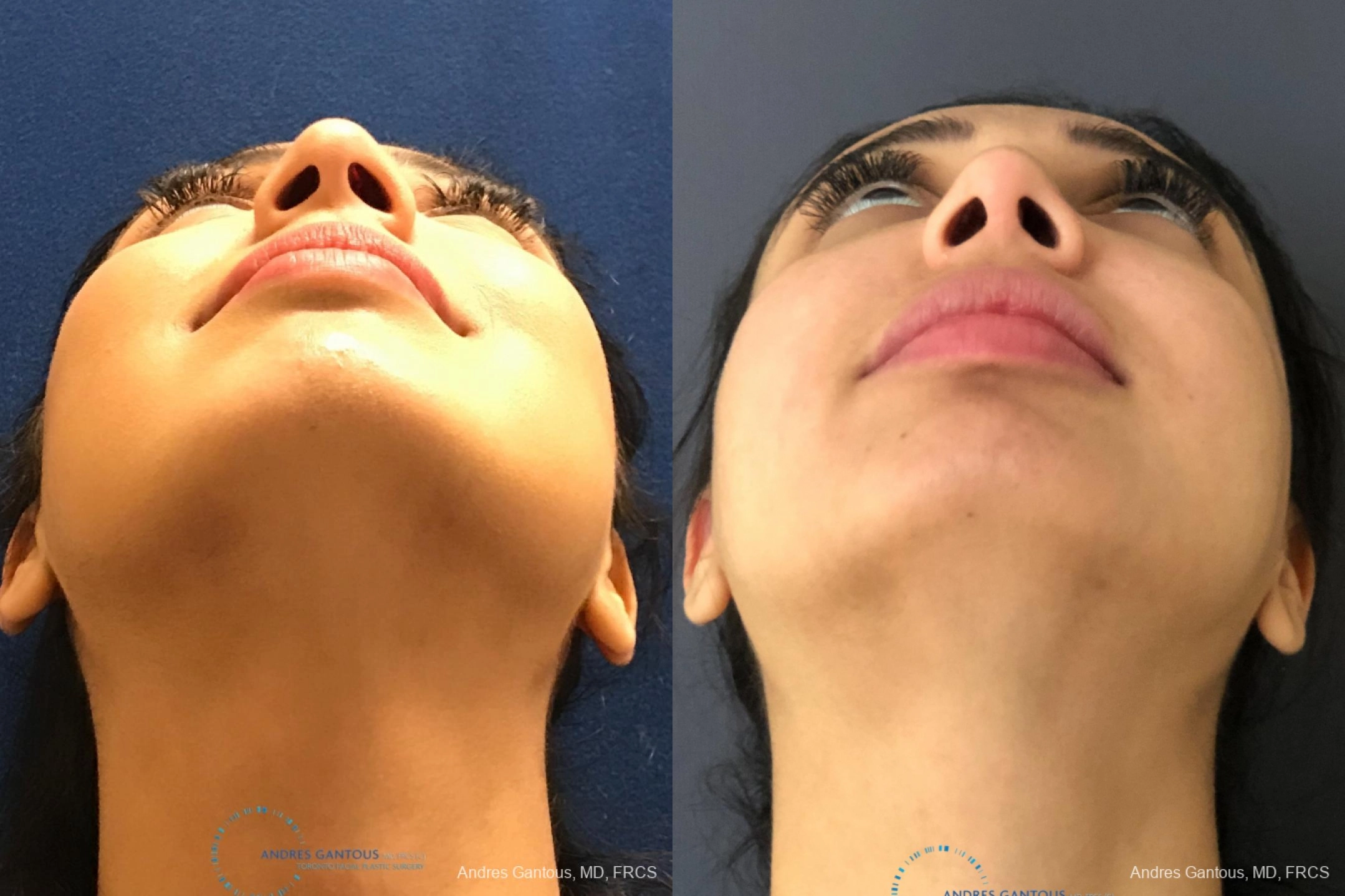 Rhinoplasty - Thumbnail 2