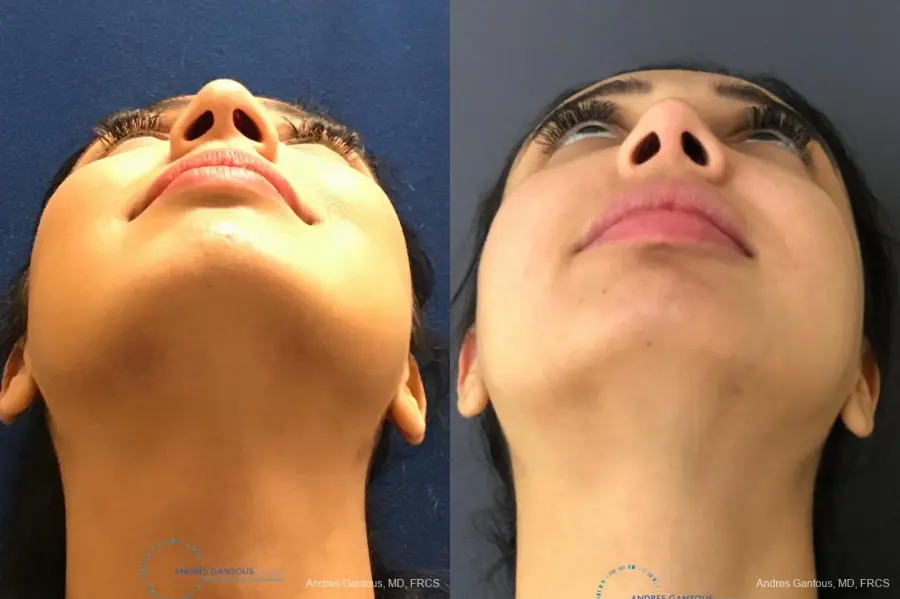Rhinoplasty: Patient 75 - Before and After 2