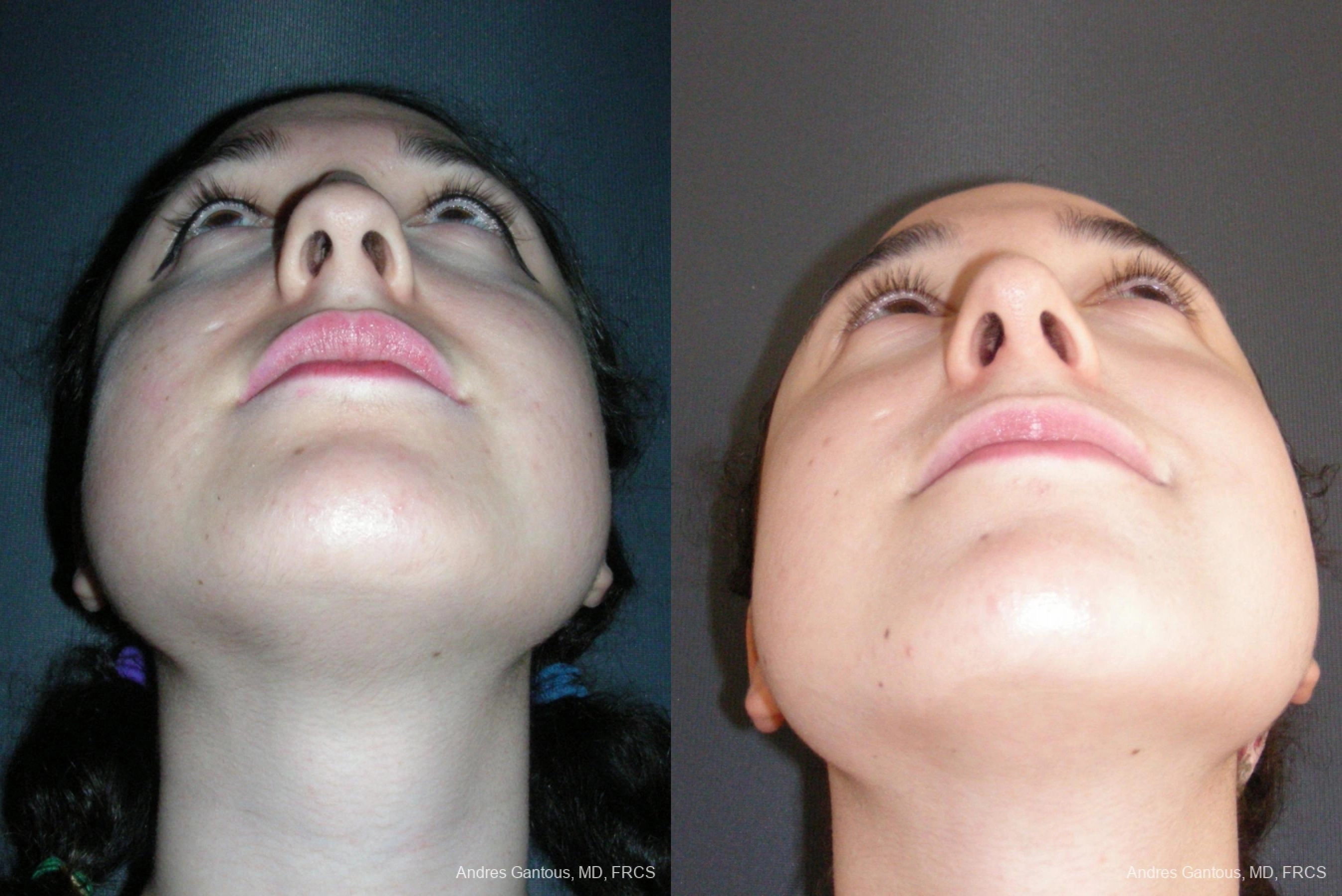 Rhinoplasty - Thumbnail 6