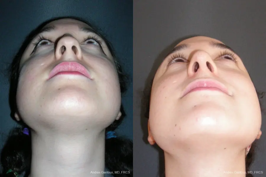 Rhinoplasty: Patient 57 - Before and After 6