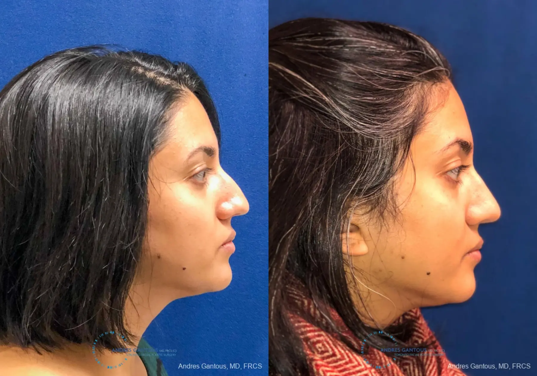 Rhinoplasty: Patient 80 - Before and After 5