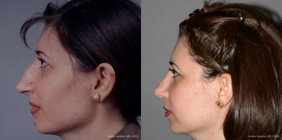 Rhinoplasty: Patient 41 - Before and After 5