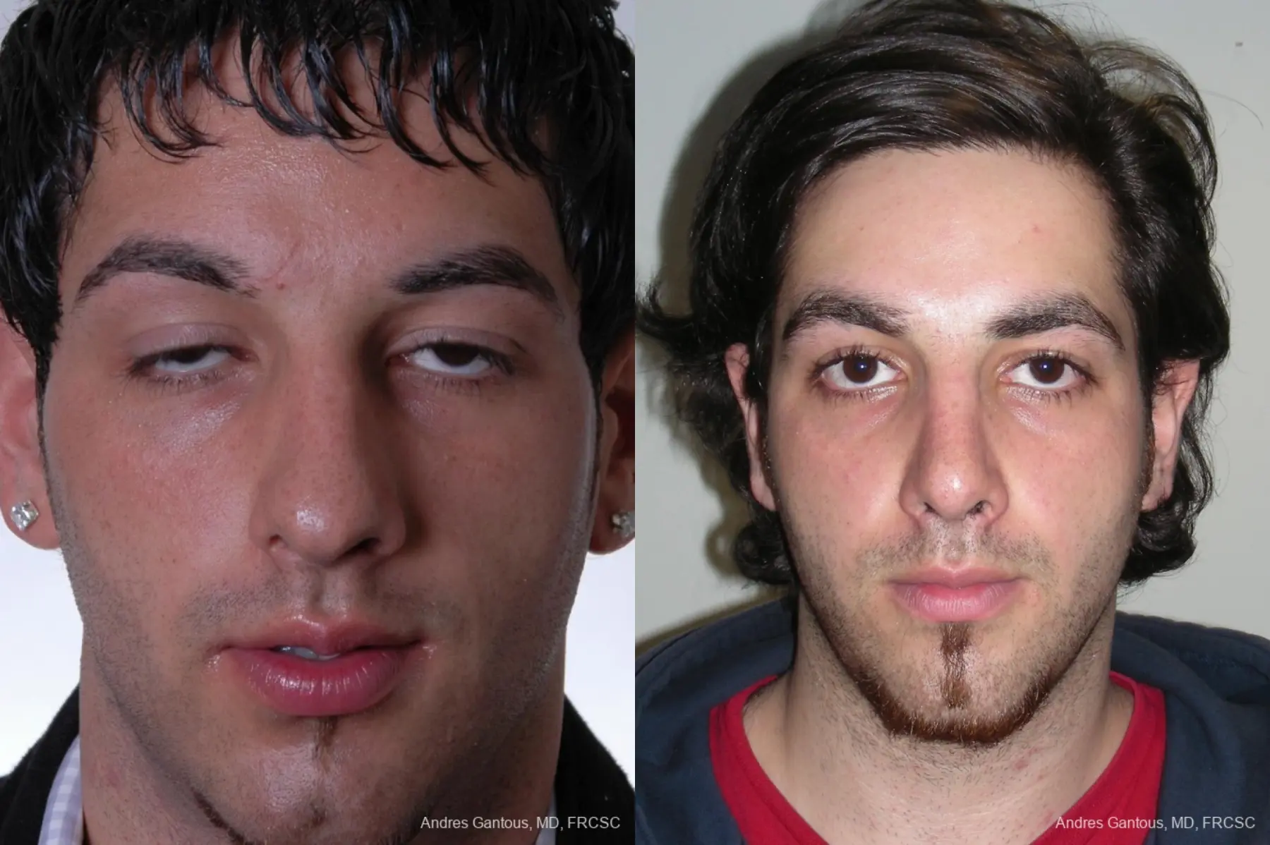 Rhinoplasty: Patient 12 - Before and After  