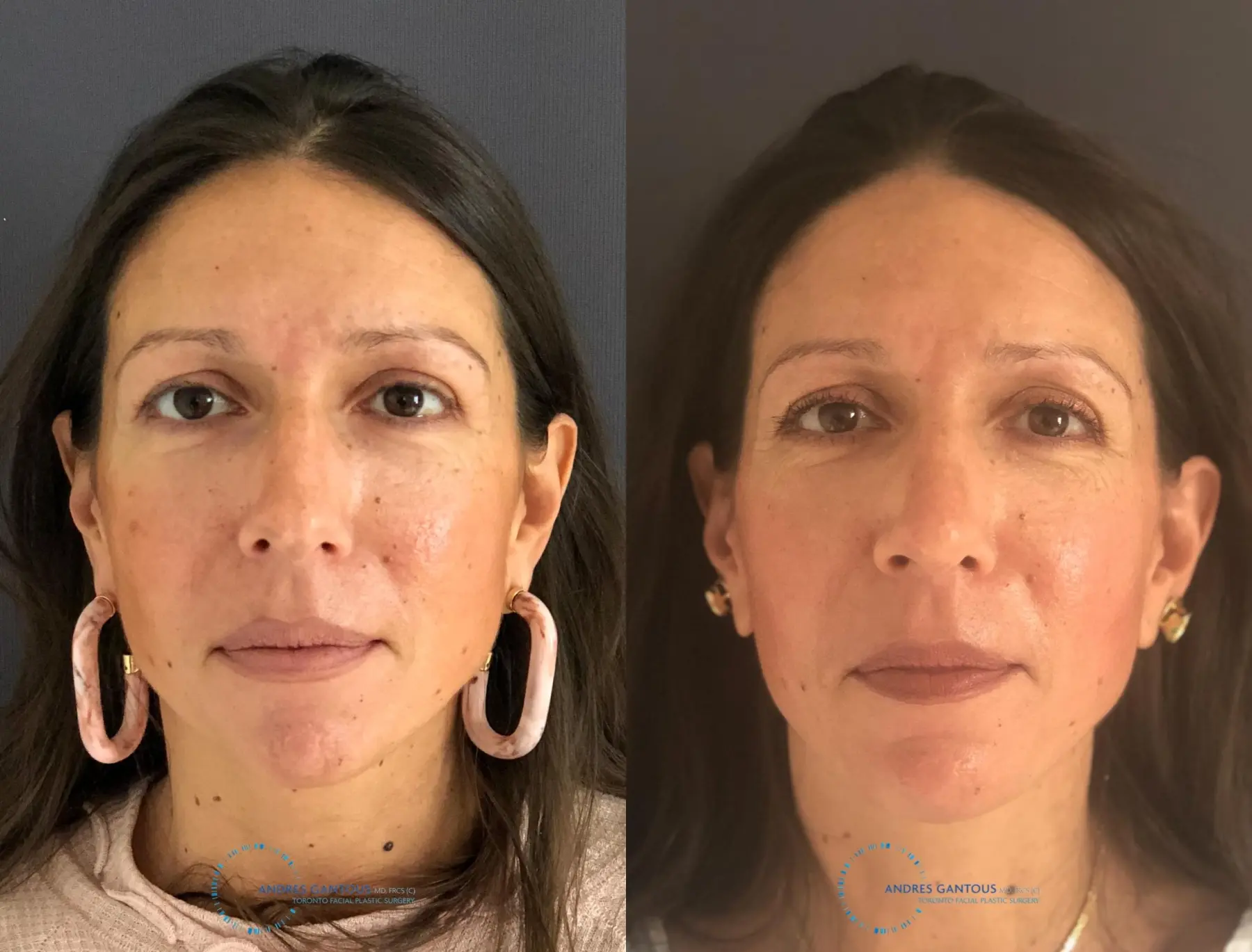 Rhinoplasty: Patient 8 - Before and After  