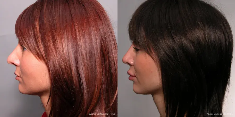 Rhinoplasty: Patient 36 - Before and After 3