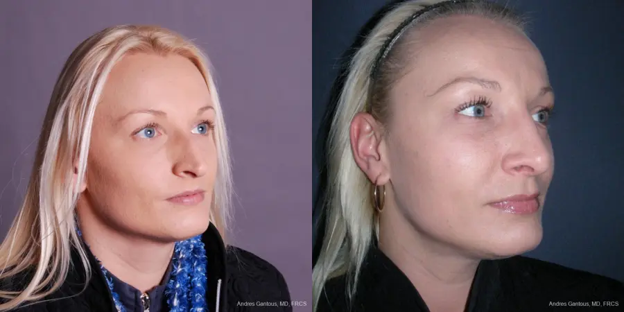 Rhinoplasty: Patient 48 - Before and After 2