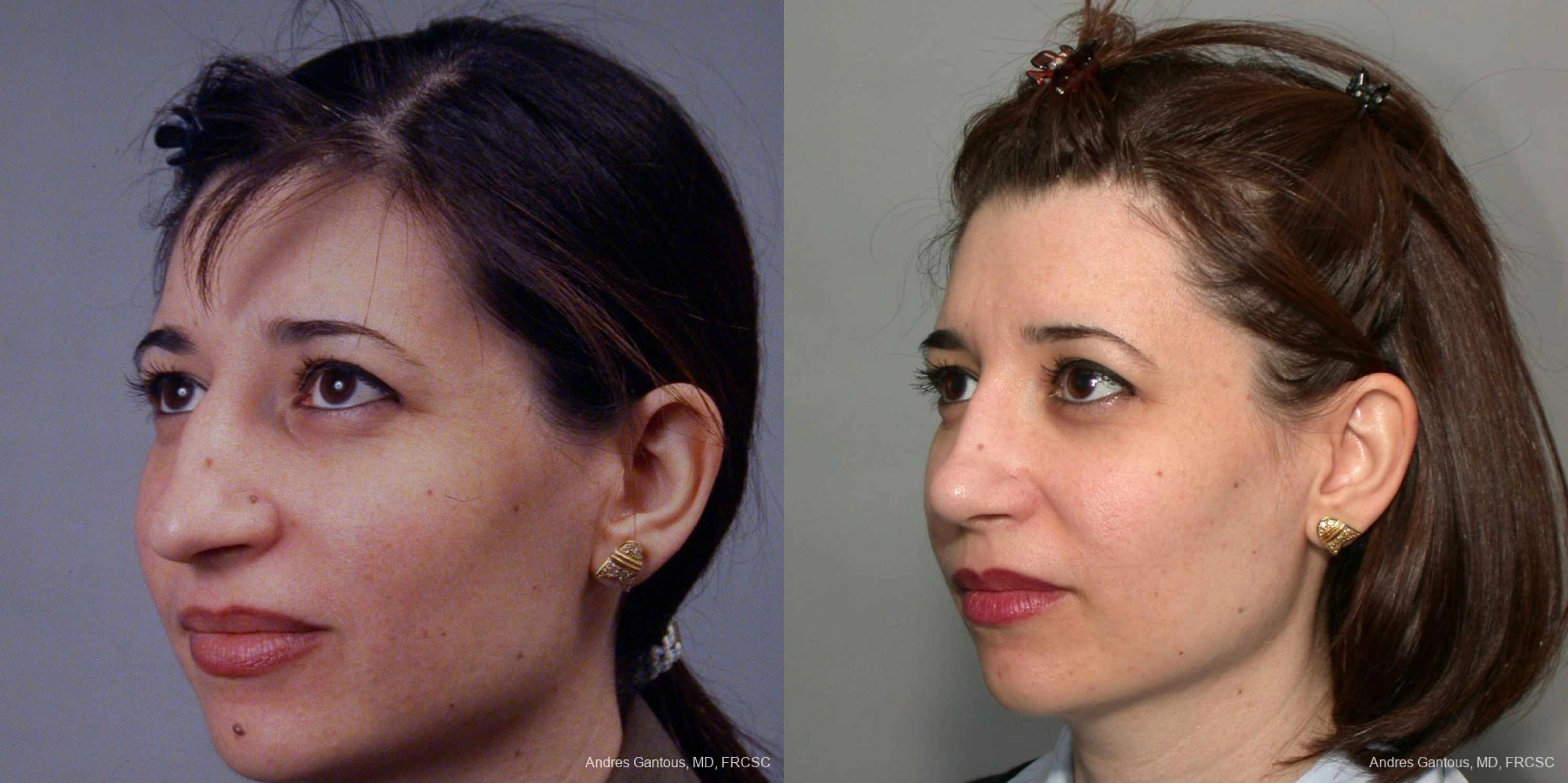 Rhinoplasty - Thumbnail 2