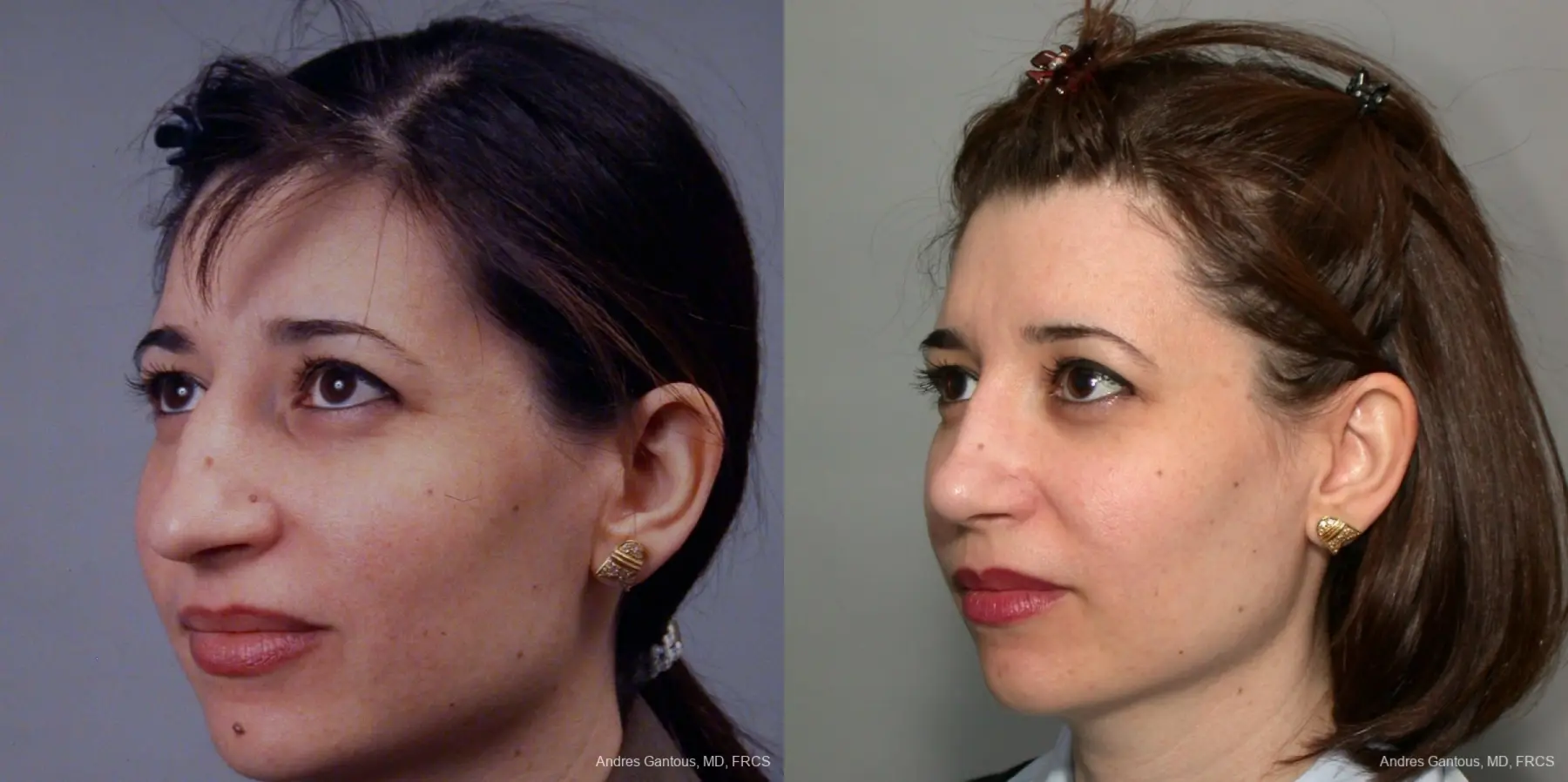 Rhinoplasty: Patient 41 - Before and After 2