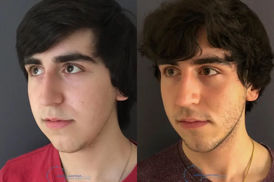 Rhinoplasty: Patient 67 - Before and After 4