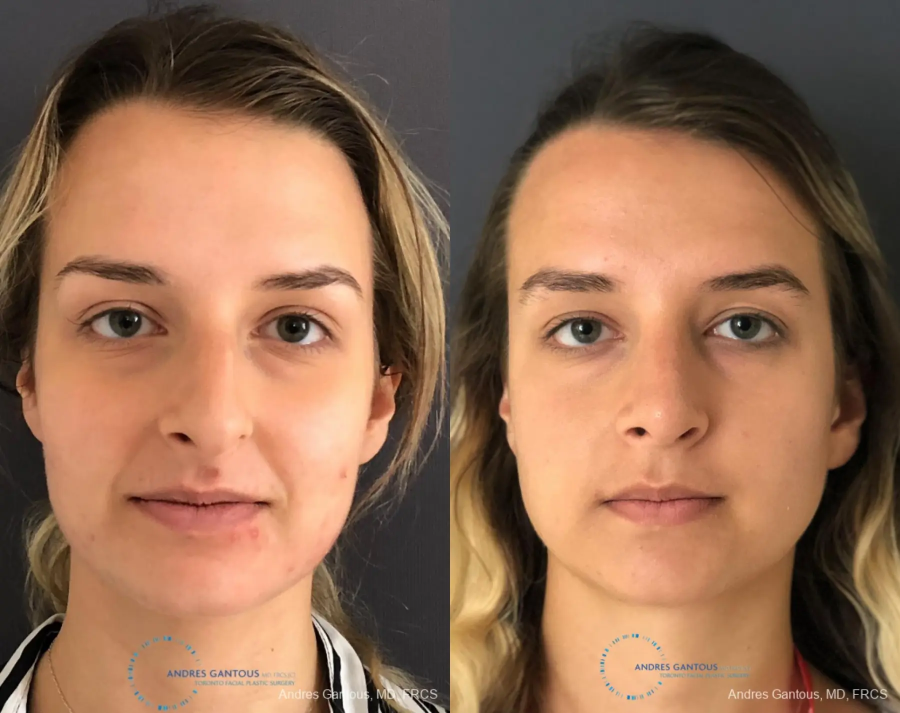 Rhinoplasty: Patient 86 - Before and After  