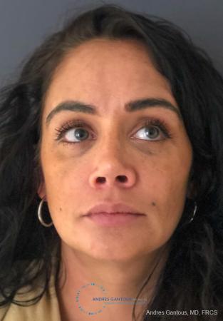 Revision Rhinoplasty: Patient 13 - After
